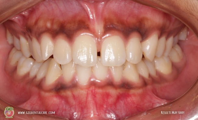 gio-self-ligating-braces